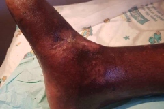 image-before-wound-heal-8-weeks