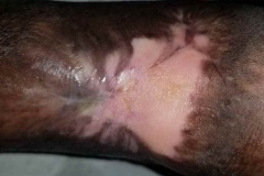 image-diabetic-after-13weeks-wound-heal