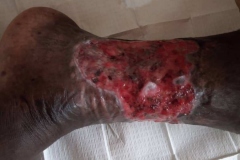 image-sure-wound-care-2020-16
