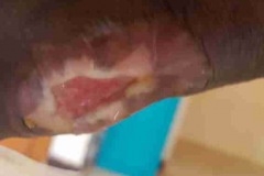 image-sure-wound-care-2020-6